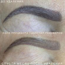 Удаление перманентного макияжа ремувером в Хабаровске